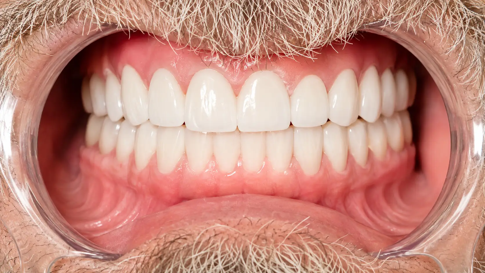 After veneers