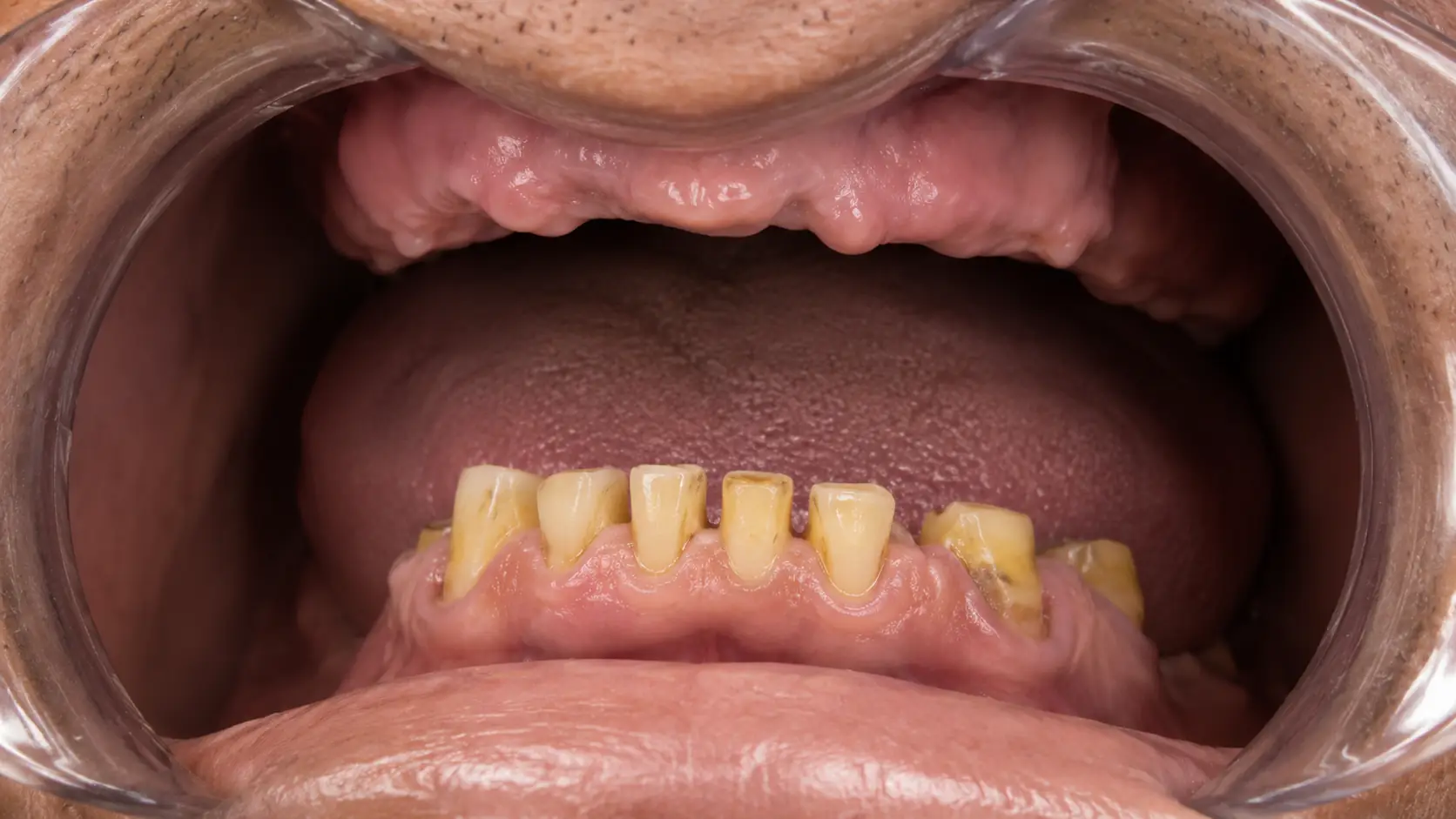 Before veneers